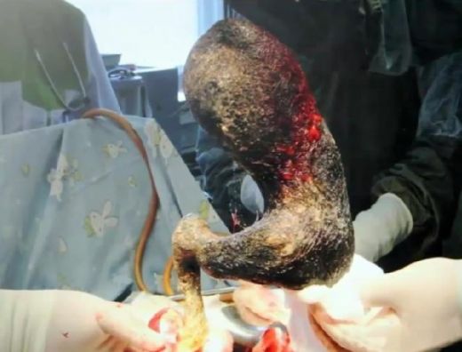 Vājprāta murgs! Ārsti sievietei no kuņģa izņem 4 kilogramus matu - VIDEO